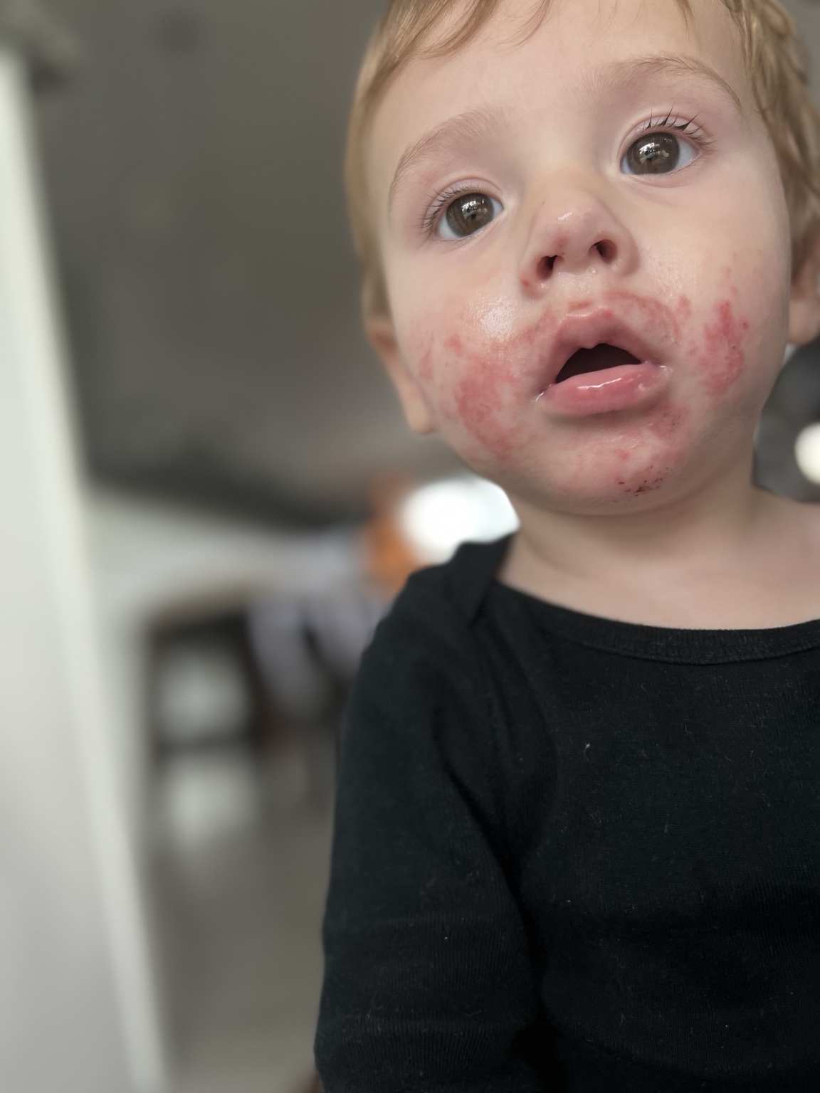 Charlie wearing a black shirt, with visible redness around his cheeks and chin